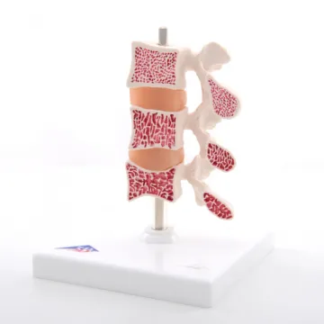 3B Scientific Osteoporose Modell deluxe 3 Wirbel